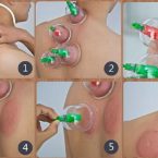 cupping info