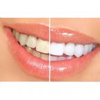 Teeth Whitening Dental Bleaching Kit iwth Whitening Light (2)